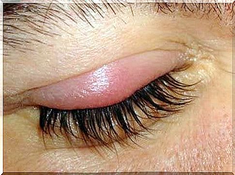 A red and inflamed eye.