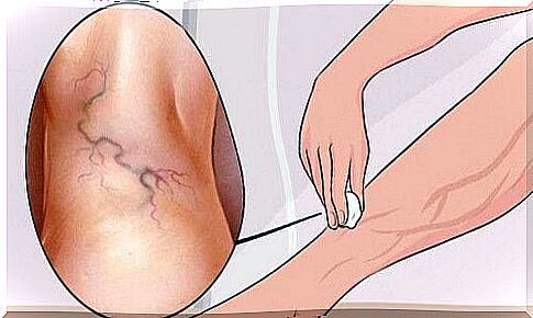 8 exercises to treat varicose veins