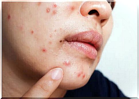 Benefits and side effects of using isotretinoin for acne