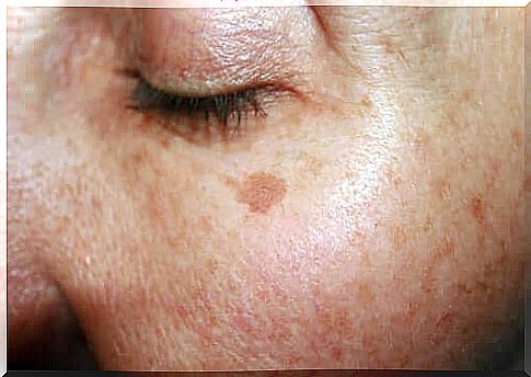 Moles and beauty spots on face