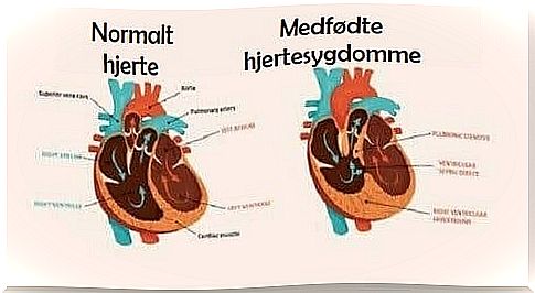 Illustration of congenital heart disease