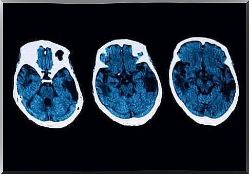 Diagnosis and treatment of posterior cortical atrophy