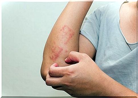 In its most common form, psoriasis manifests itself as thick, reddish skin spots that cause itching and discomfort