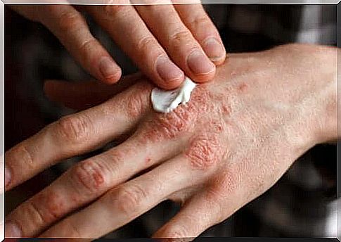 Person comes cream on hand with psoriasis