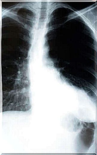 How pneumonia affects the body