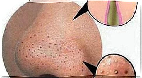 How to remove pimples and blackheads naturally