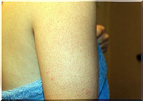 How to remove pimples on your arms