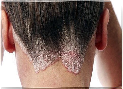 How To Treat Dandruff And Seborrheic Eczema At Home!