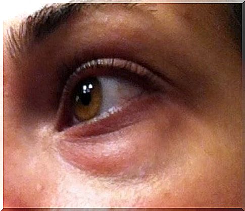 How to treat the dark bags under the eyes naturally