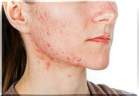 Isotretinoin is a drug used in the most severe cases of acne