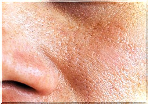 Natural remedies for enlarged pores