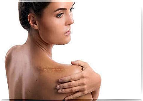 Woman with scar on shoulder from rotator cuff injury