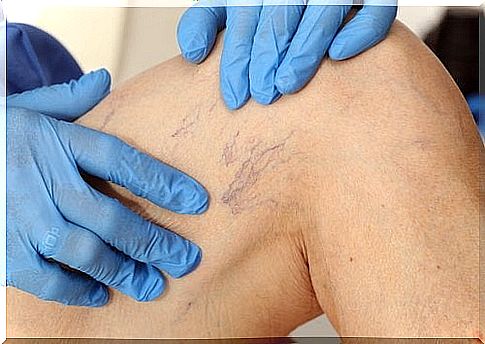 varicose veins at the knee