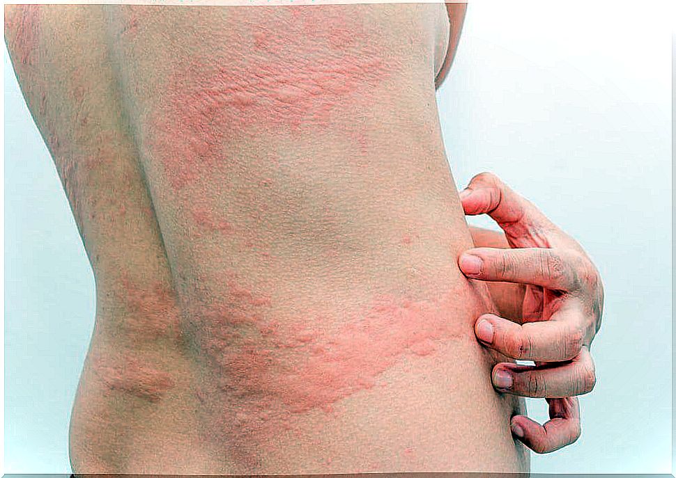 Three natural remedies for hives