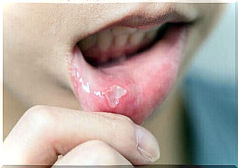 Treatment of cold sores in children