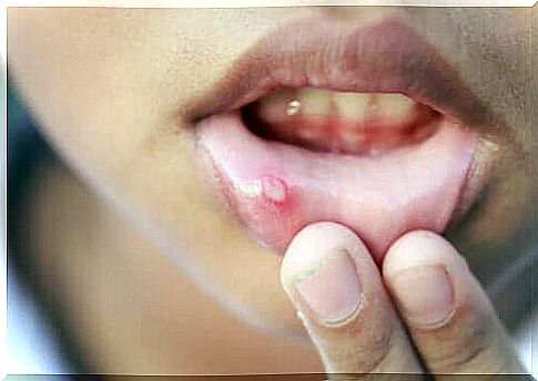 Close-up of cold sores in children