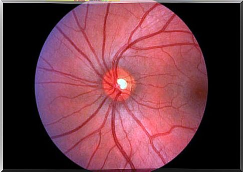 Illustration of papilloedema in the eye