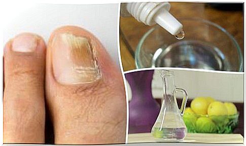 You can fight nail fungus naturally with 3 ingredients